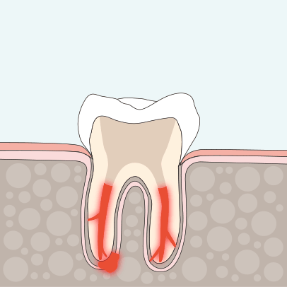 Endodontie Wurzelkanalbehandlung