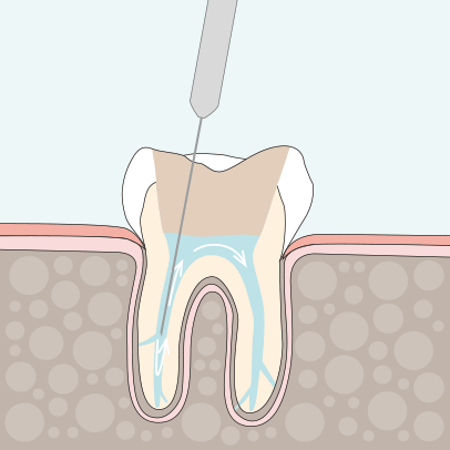 Endodontie Wurzelkanalbehandlung