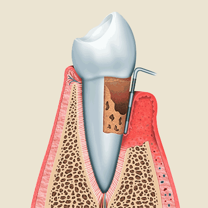 Parodontitis